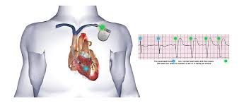 Image result for Internal Cardiac Defibrillator