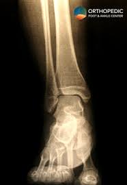 Image result for Ankle XRay