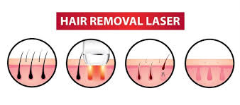 How does ipl hair removal work? Belle Bella Ipl Hair Removal Review Is It Really The Best Laser Hair Removal Machine My Shopping Station
