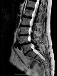 Maybe you would like to learn more about one of these? Stabilisierungsoperationen Bei Degenerativen Veranderungen Und Nach Traumata Der Lws Neurochirurgische Gemeinschaftspraxis Greifswald