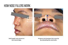 The wrong injecting strategy can make you look older or worse. Nose Fillers In Singapore Sl Aesthetic Clinic