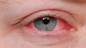 Coronavirus Pink Eye Could Be Rare Symptom Of Covid 19