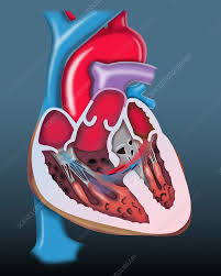 Image result for Ventricular Septal Defect