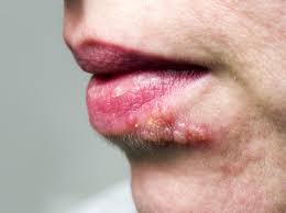 Ab wann ist herpes ansteckend kann schon einfacher beantwortet werden. Lippenherpes Das Bekannteste Herpesvirus Herpes Guru