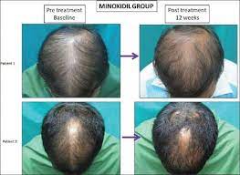Microneedling is now a therapy that you can use to treat hair loss. Derma Roller For Hair Loss Glow Up Skincare