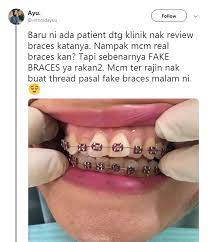 Berapa harga nak pakai braces ye? Gadis Ini Pesan Elak Pasang Fake Braces Dekat Butik Kos Tak Sampai Rm1k Sebab Kesannya Mengerikan Hijabista