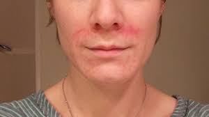 Perioral Dermatitis Your Ultimate Guide To Long Term Healing Perioral Dermatitis Perioral Eczema Treatment