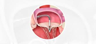 The mitraclip® is the latest treatment for mitral valve regurgitation. Mitraclip Shawn Yazdani Md