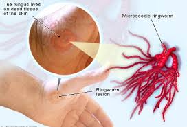 Ringworm Treatment Pictures Causes And Symptoms Ringworm in humans typically looks like a circular, red rash on the skin. ringworm treatment pictures causes