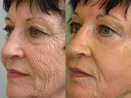 Pin On Chemical Peel
