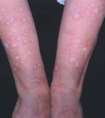 Image result for Neurotic Excoriation