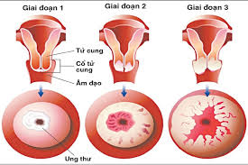 Các địa phương đang thực hiện giãn cách xã hội theo chỉ thị 16 thì phải thực hiện nghiêm, thực chất, hiệu quả, chắc chắn, chặt (bệnh nhân) để tổ chức quản lý, theo dõi và trợ giúp y tế phù hợp, giảm tỷ lệ người chưa có triệu chứng diễn biến thành có triệu chứng; Ung ThÆ° Cá»• Tá»­ Cung Giai Ä'oáº¡n Ä'áº§u Co Biá»ƒu Hiá»‡n NhÆ° Tháº¿ Nao Medlatec
