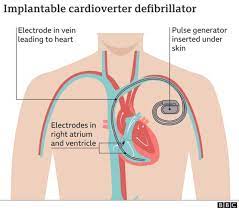 The wires with electrodes on the ends are inserted into the heart through a vein in the upper chest. Heart Starting Device Christian Eriksen Go Get Icd Implantable Cardioverter Defibrillator Implant Afta Cardiac Arrest Bbc News Pidgin