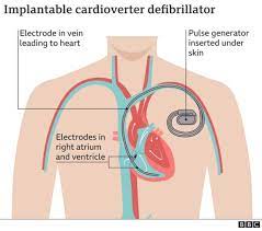 Wires (called leads) connect the icd to the heart. Heart Starting Device Christian Eriksen Go Get Icd Implantable Cardioverter Defibrillator Implant Afta Cardiac Arrest Bbc News Pidgin