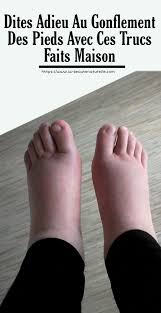 Dites Adieu Au Gonflement Des Pieds Avec Ces Trucs Faits Maison Pied Gonfle Pied Enfle Soin Des Pieds