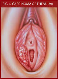 Image result for Vulvar Cancer