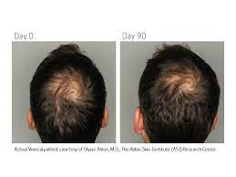 Viviscal for example is a top selling hair growth treatment employed by many alopecia sufferers to help with hair loss. Viviscal Man 180 Tabs By Viviscal Dubai Supplements