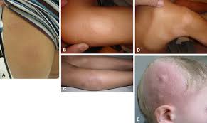 Your hair loss generally can't be prevented or controlled, but it can be managed. References In Juvenile Mycosis Fungoides Cutaneous T Cell Lymphoma With Frequent Follicular Involvement Journal Of The American Academy Of Dermatology