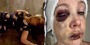 Cincinnati beatdown victim reveals 'very bad brain trauma' in first remarks  since viral assault