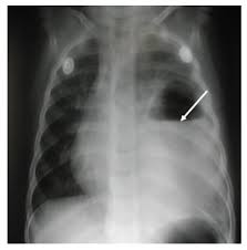 Image result for Lung Abscess