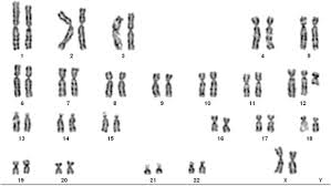 The extra genetic material from isochromosome 12p disrupts the normal course of development, causing the characteristic features of this disorder. Pallister Killian Syndrome Cytogenetics And Molecular Investigations Of Mosaic Tetrasomy 12p In Prenatal Chorionic Villus And In Amniocytes Strategy Of Prenatal Diagnosis Sciencedirect