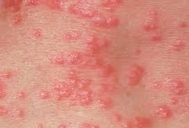 Image result for scabies on human skin