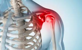 Capsulite adesiva - Dra. Verônica Chang | Especialista Ombro e Cotovelo