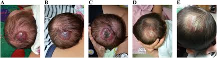 As your body gets used to the medicine these side effects may disappear. Intolerable Side Effects During Propranolol Therapy For Infantile Hemangioma Frequency Risk Factors And Management Scientific Reports