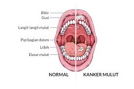 Jenis makanan dan minuman yang terhasil melalui proses. Kanker Mulut Gejala Penyebab Dan Mengobati Alodokter