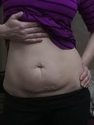Mom Belly Will I Ever Lose This Loose Skin Fat I Still Have Some Body Fat To Lose I M 5 9 And Around 150 Lb I Had My Last Child At 36 I M 40