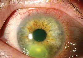 Understanding Corneal Infection Care