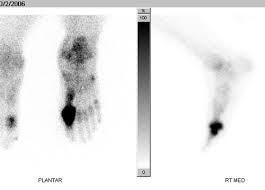 Image result for Osteomyelitis Bone Scan