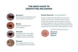 A change in your skin is the most common sign of skin cancer. Kenali Melanoma Dengan Abcd Kanker