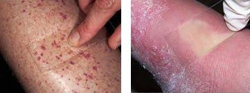 Purpura and Vasculitis - Vasculitis-Causes-Symptoms-Diagnosis- | Homeopathic | Best Homeopathic Doctor in Pakistan | Dr Qaisar Ahmed MD, DHMS