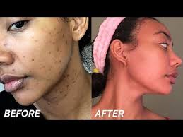 When it comes to getting rid of hyperpigmentation, retinol is the queen. How To Get Rid Of Dark Spots On Face Causes Prevention