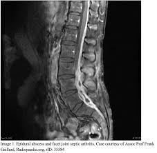 Image result for Spinal Epidural Abscess