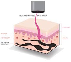 How does piqo4 remove tattoos? How Does Laser Tattoo Removal Work Skin Medical