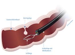 Darmkrebs entwickelt sich fast immer aus abnormalen wucherungen der darmwand, den so genannten präkanzerösen polypen, die in das innere von. Koloskopie Wikipedia