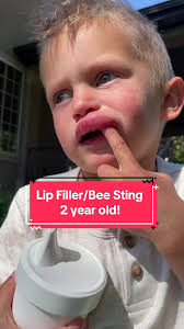 Little Boy Who Got Stung by Bee and Died