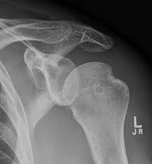 Hill Sachs Lesion Compression Defect At The Top Of The Humeral Head At The Posterolateral Aspect It Is A Sign Of Radiology Shoulder Dislocation Dislocation