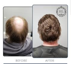 A lot of experts are recommending supplements and a high protein diet to fight post covid hair loss, but no one seems to be talking about your gut health.focusing on a healthy digestive system. Male Pattern Baldness Hair Replacement System Non Surgical Solution Hair Restoration Hair Replacement Systems Hairstyles For Thin Hair