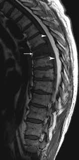 Case 148 Thoracic Epidural Lipomatosis Radiology