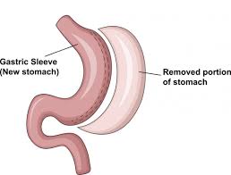 gastric sleeve diet what you can and cant eat and when