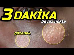 Sadece 3 Dakikada Beyaz Nokta Ve Gozenek Yok Edici Yontem Sok Etki Guzellik Bakim Youtube 2020 Nokta Bakken Guzellik