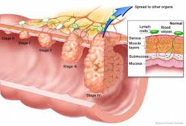 Colon cancer often develops from adenomatous polyps. Colon Cancer Expanded Version Ascrs