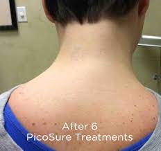 Tattoo removal & lightening the all natural way to remove tattoos unlike other tattoo removal methods, saline based solution removal is far less painful and has fewer side effects, than any tattoo removal method that exists today. Picosure Laser Tattoo Removal Phoenix Tattoo Removal Scottsdale Tattoo Removal