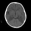 It is reasonable to obtain an mri when patients are asymptomatic to ensure that no other abnormality is present which may be causing a recurrent chemical meningitis (e.g. Https Encrypted Tbn0 Gstatic Com Images Q Tbn And9gcrvfce9y0 Nxynjq Ij Zoyvaaquu7t6yjy83i Ag Usqp Cau