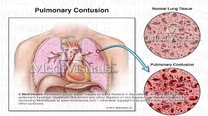 Image result for Pulmonary Contusion