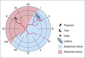 Techniques Of Scleral Buckling Clinical Gate