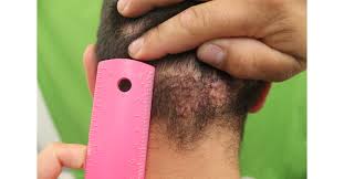 Here's why ingrown hairs form and how you can get rid of and prevent them for good. Groundbreaking Discoveries For Treatment Of Back Of Head Razor Bumps